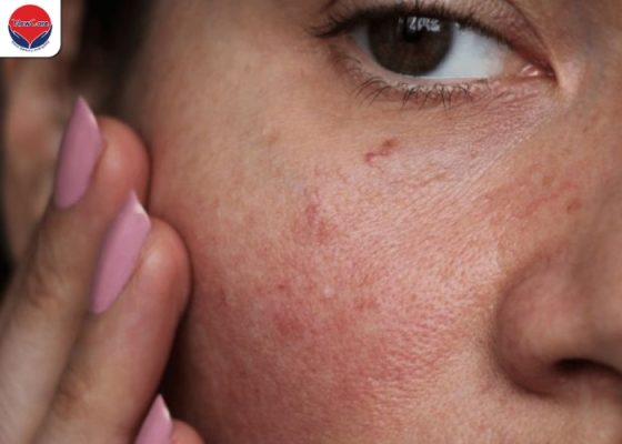 Nguyên nhân bôi kem chống nắng bị nóng mặt