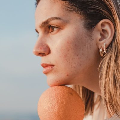 Giải đáp thắc mắc khi bôi kem chống nắng cho da mụn