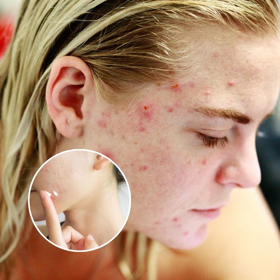 Giải đáp| Bị mụn có nên bôi kem chống nắng không?